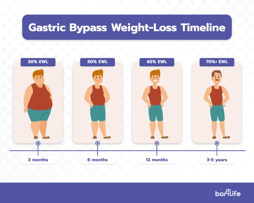Gastric Bypass Surgery Weight Loss Chart My XXX Hot Girl