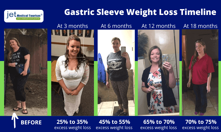 Gastric Sleeve Weight Loss Chart And Timeline 2021